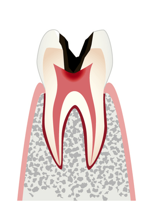 歯髄(神経)まで進行したむし歯