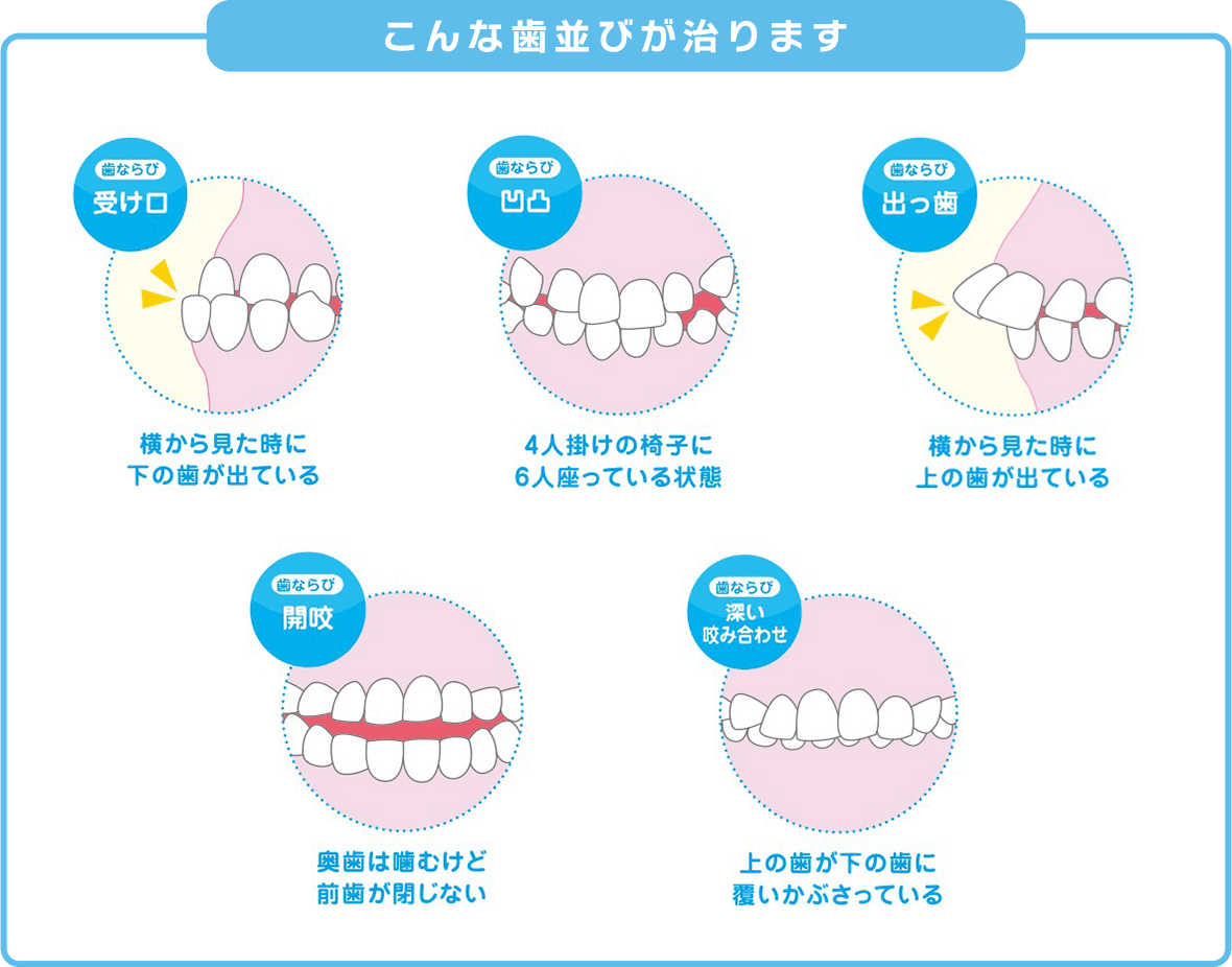 プレオルソ 歯並び例